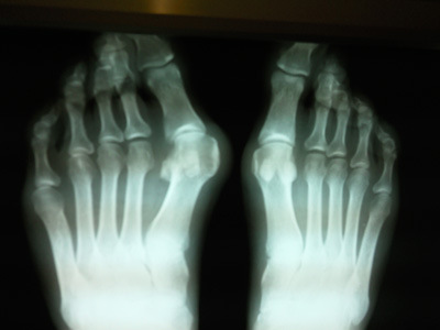 Воспаление сустава пальца ноги