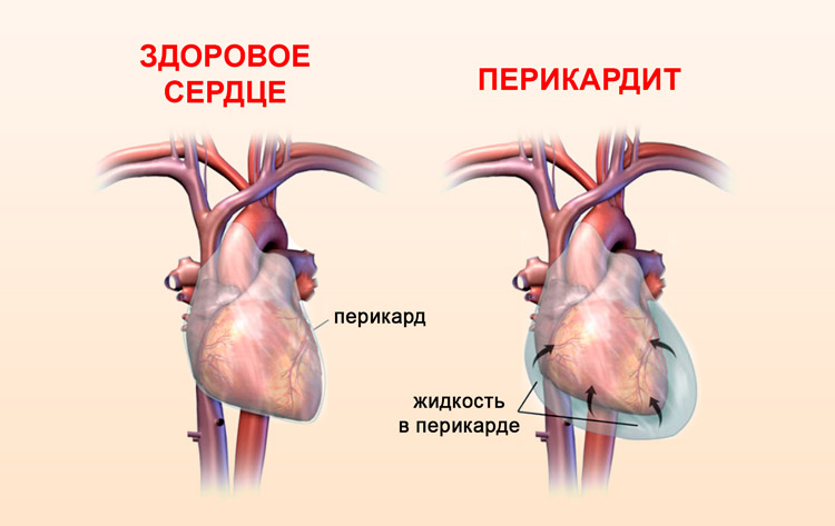 Воспаление оболочки сердца при перикардите