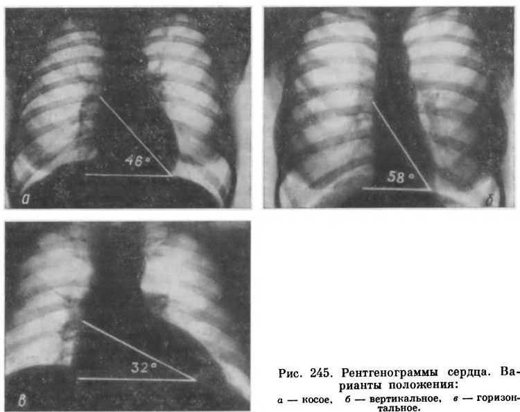 Рентгенография сердца поможет обнаружить патологию сердца или остеохондроз