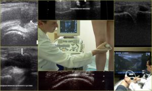 УЗИ рентген или МРТ коленного сустава что лучше выбрать