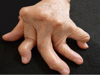 Как живёте с ревматоидным артритом