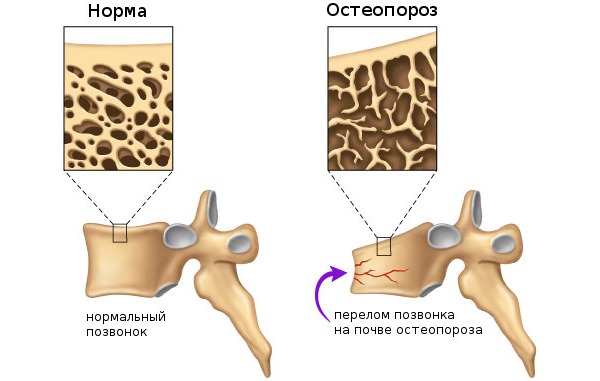 Особенности возникновения остеопороза у мужчин