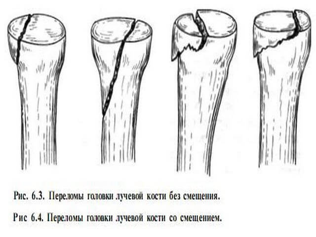Как разработать руку после перелома лучевой кости