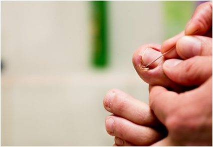 Как снять боль от врастающего ногтя
