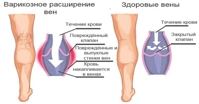 Тромбоз ноги симптомы и лечение фото
