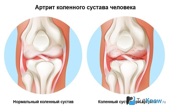 Лечение заболеваний суставов спорт при ревматоидном артрите