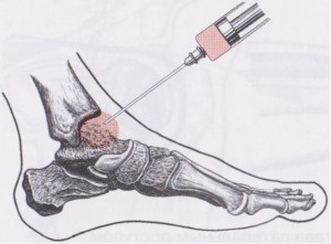 Причины, проявления и лечение дисторсии лучезапястного сустава