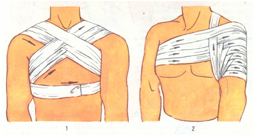 Колосовидная повязка на плечевой сустав техника наложения, сроки использования