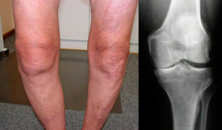 Положена ли инвалидность при деформирующем артроз колена и как её получить