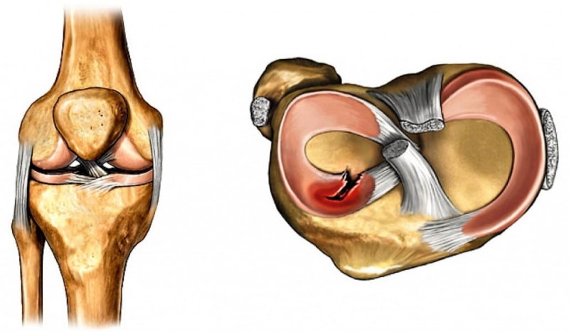 Реабилитация после удаления мениска коленного сустава