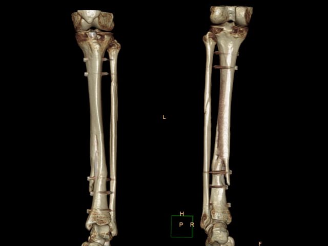 Переломы нижних конечностей - рефератТравматологическое отделение