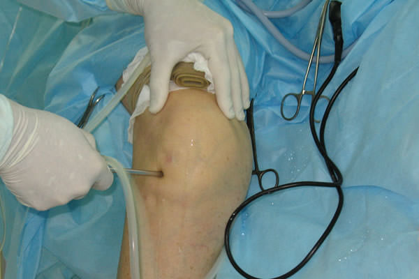 Повреждение коллатеральной связки коленного сустава лечение