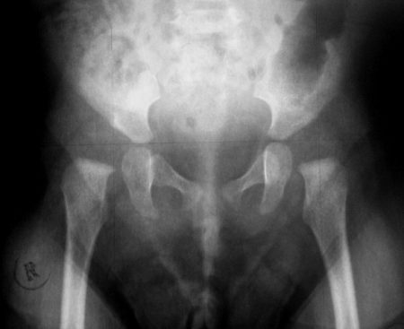 Рентген тазобедренных суставов и костей таза показания, подготовка, особенности обследования взрослых и детей
