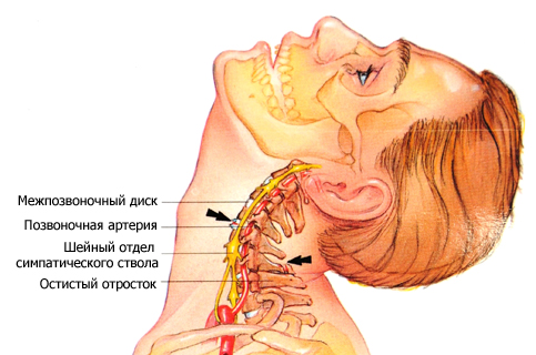 Симптомы поясничного остеохондроза у мужчин и женщин