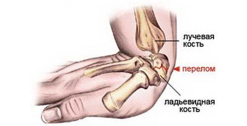 Как разрабатывать руку после перелома лучевой кости в типичном месте