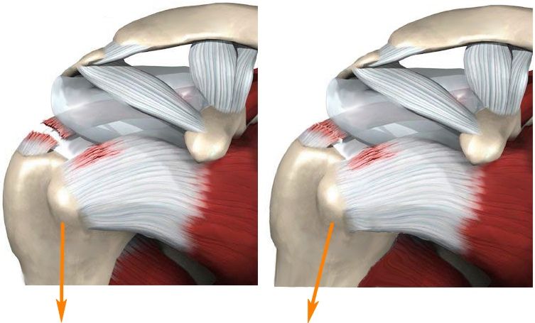 Разрыв капсулы плечевого сустава