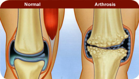 Положена ли инвалидность при деформирующем артроз колена и как её получить