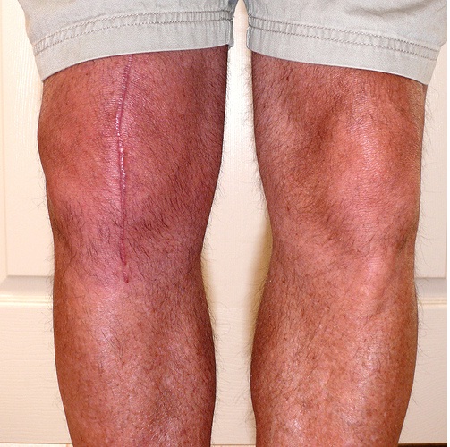 Лечение суставовЭндопротезирование коленного сустава по квоте в москве