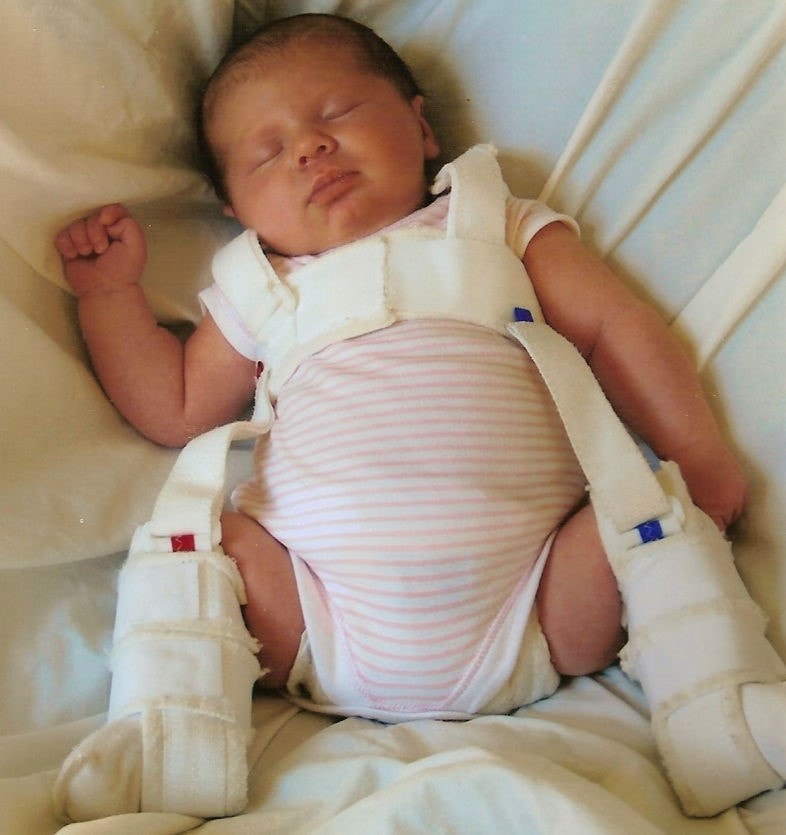 Вывих тазобедренного сустава у малыша