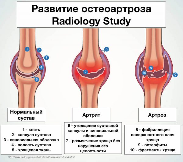 Классификация остеоартроза