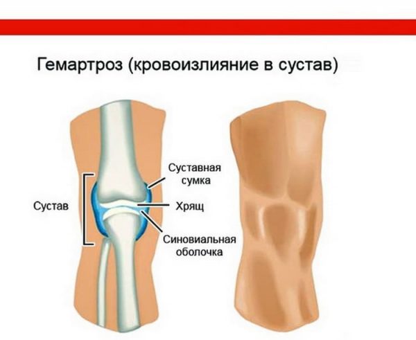 Гемартроз коленного сустава 