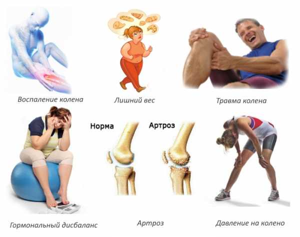 Причины артроза коленного сустава