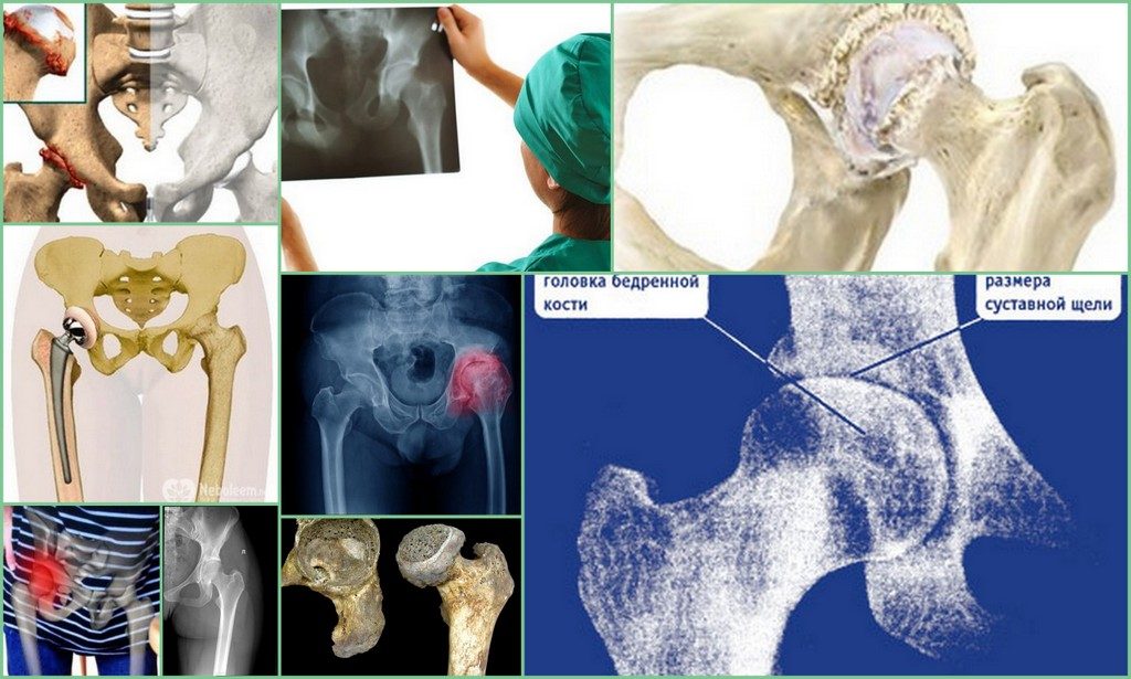 Компьютерная томография тазобедренных суставов