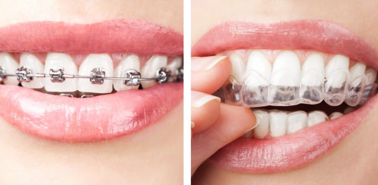 Применение брекет-систем и кап для зубов