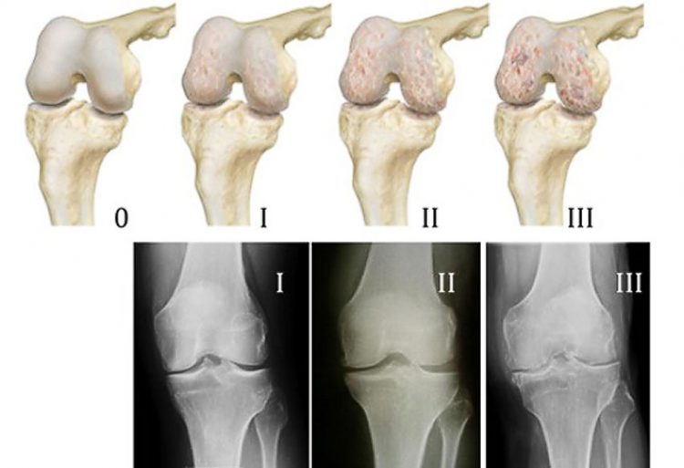 Изменение коленного сустава при артрозе