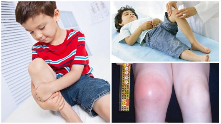 Первым симптомом артрита у ребенка может быть повышенная температура
