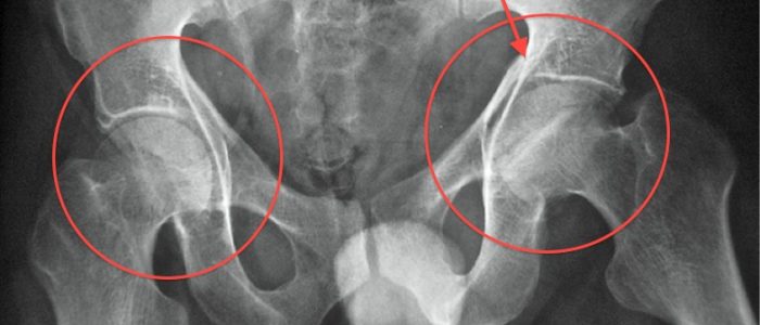 Рентген тазобедренного сустава - один из методов диагностики