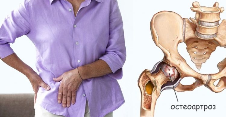 Симптомы заболевания меняются в зависимости от степени остеоартроза