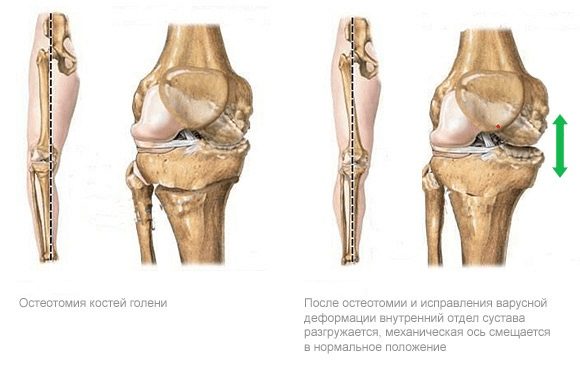 Остеотомия коленного сустава