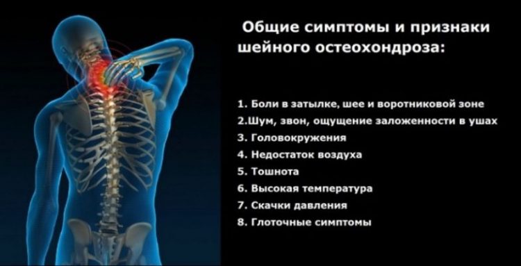 Симптомы шейного остеохондроза