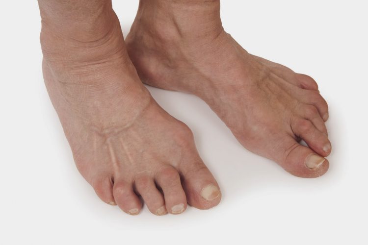 Как вылечить полиартрит ног в домашних thumbnail