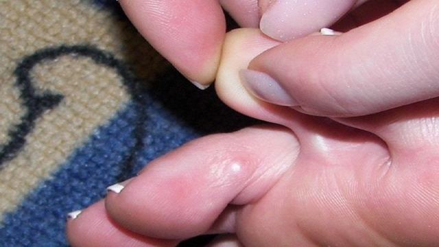 4 способа лечения сухой мозоли между пальцами ног thumbnail