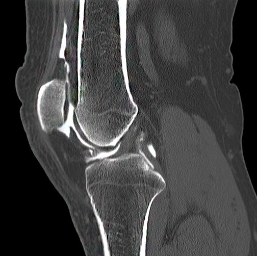 КТ коленного и других суставов как подготовится и сколько длится компьютерная томография