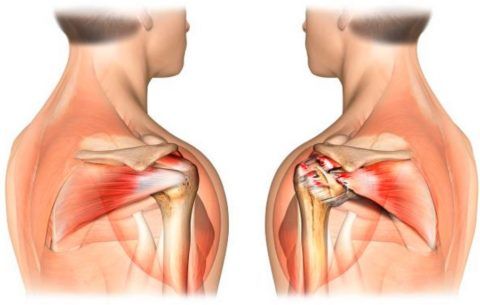 Разрыв капсулы плечевого сустава