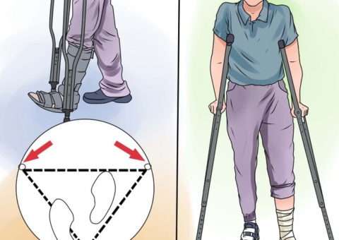 Через сколько можно ходить после перелома ноги