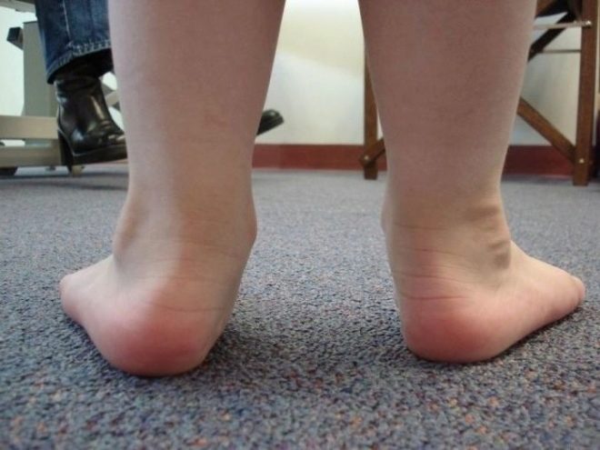 Эффективные упражнения при вальгусной деформации стопы у детей
