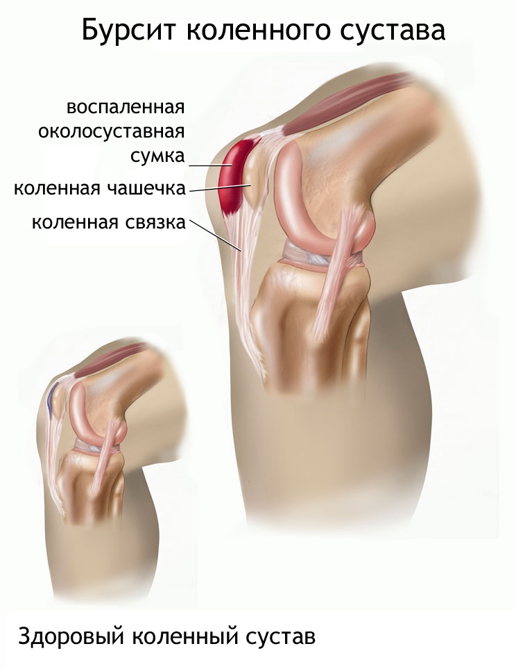 Сумки коленного сустава анатомия