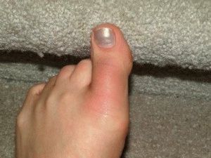 Вывих пальца на ноге. Как определить вывих пальца Лечение