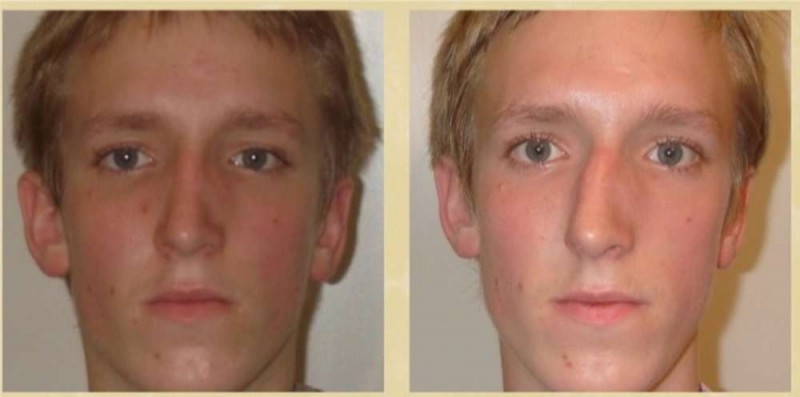 Репозиция перелома костей носа после травмы видео, фото, последствия