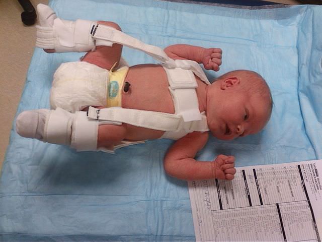 Вывих тазобедренного сустава у новорожденных: лечение и реабилитация, осложнения