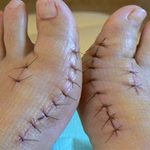 Воспаление косточки на большом пальце ноги лечение народными средствами