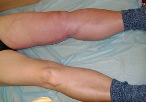 Тромбоз ноги симптомы и лечение фото