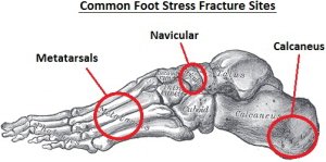Причины, проявления и лечение стрессового перелома стопы