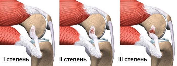 Не хрустиОперация на связки коленного сустава