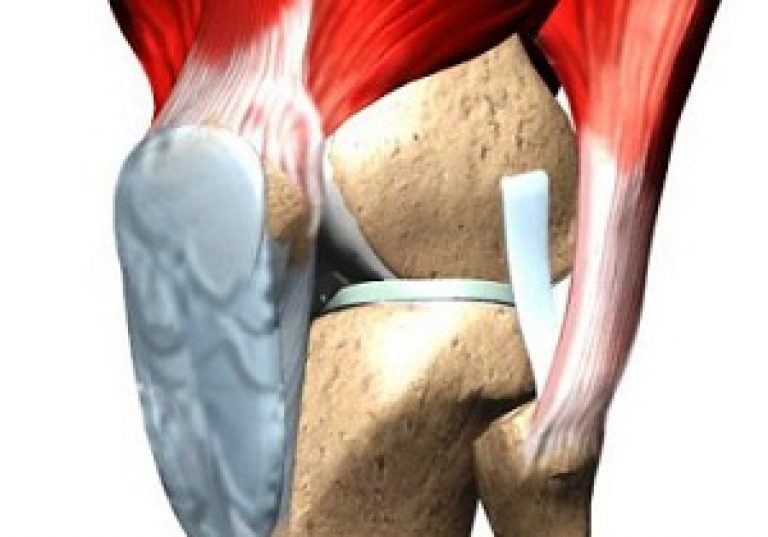 Смещение коленного сустава и чашечки симптомы, последствия и лечение