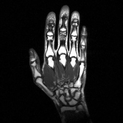 Этиология, клиника и терапия бурсита пальцев рук